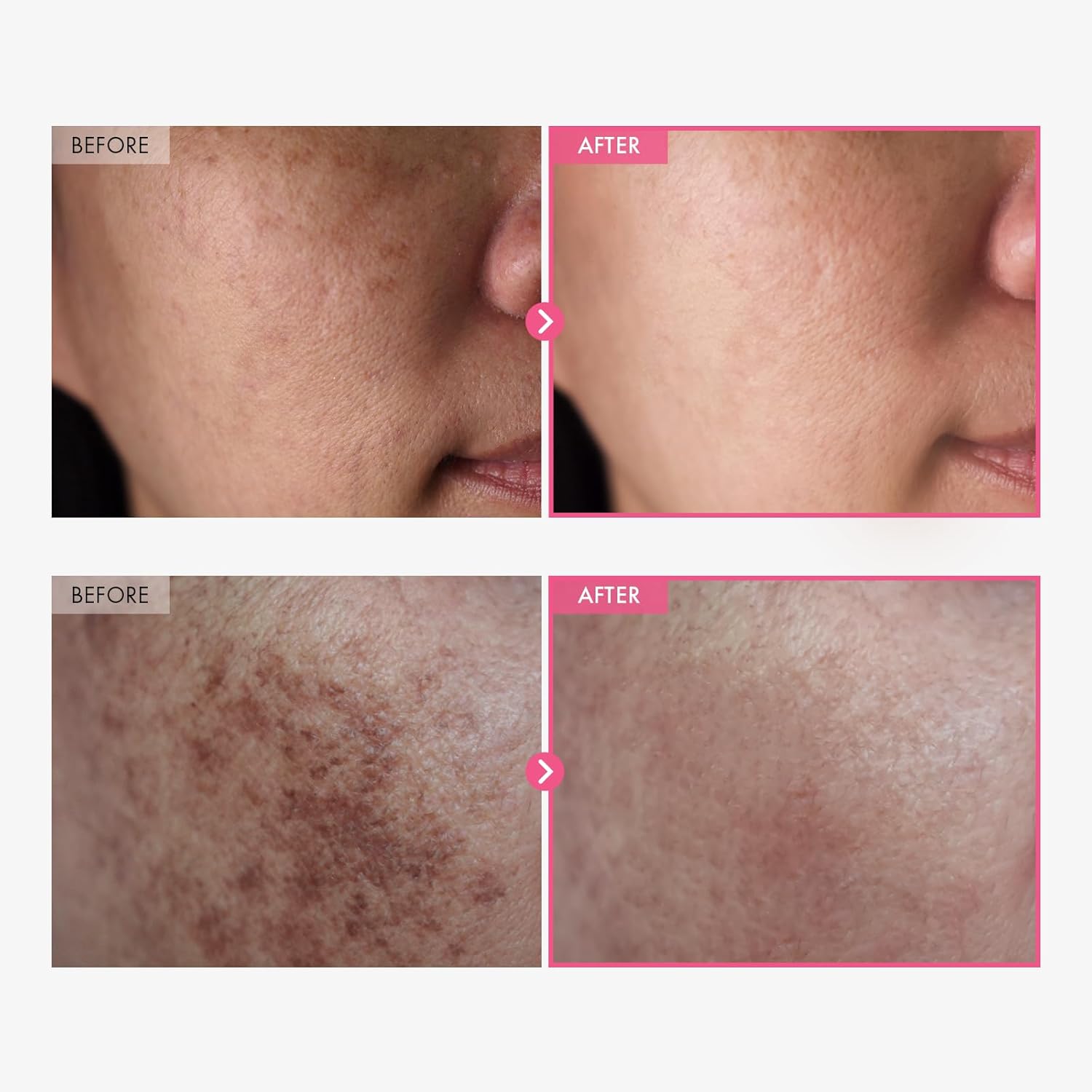 Arbutin 5% Whitening Cream
